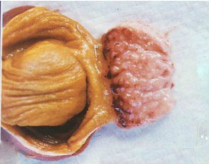 BỆNH GUMBORO TRÊN GÀ